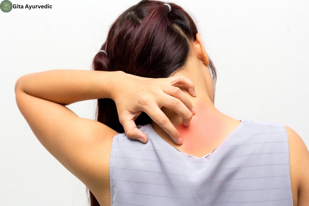 Simple Home Remedies For Skin Allergies and Rashes - gitaayurvedic.com