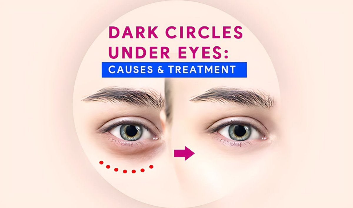 Dark circles under the eyes - gitaayurvedic.com