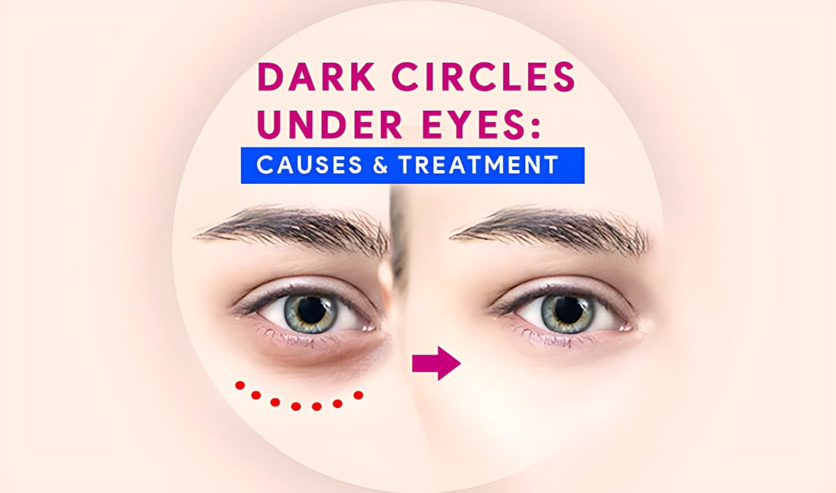 Say Goodbye to Dark Circles: Expert Tips for Under Eye Bags - gitaayurvedic.com