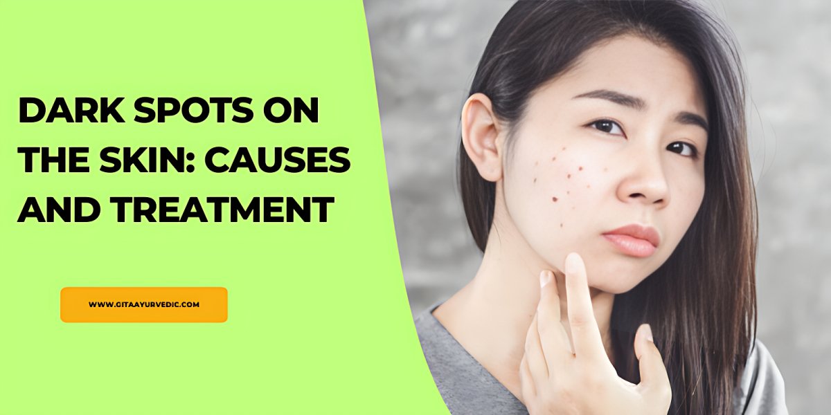 Dark spots on the skin: causes and treatment - gitaayurvedic.com