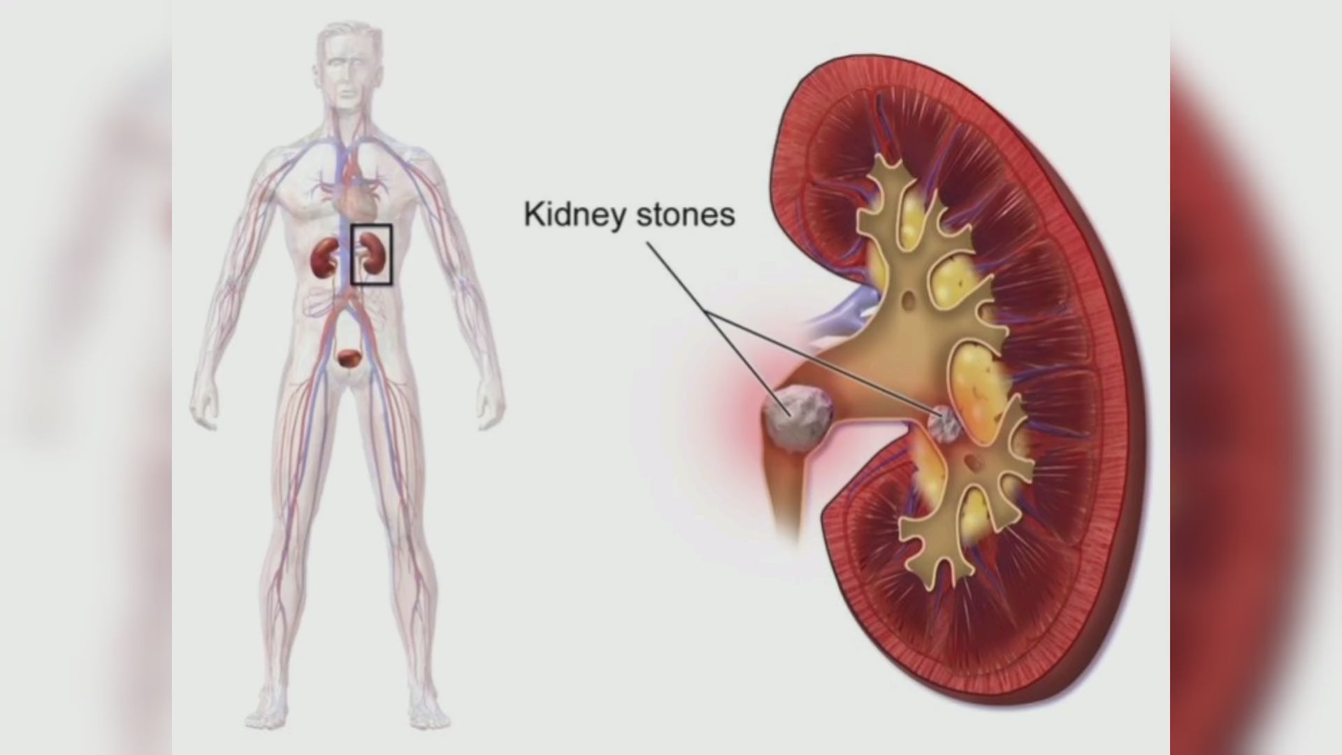 Ayurvedic UTI & Kidney Stone Support