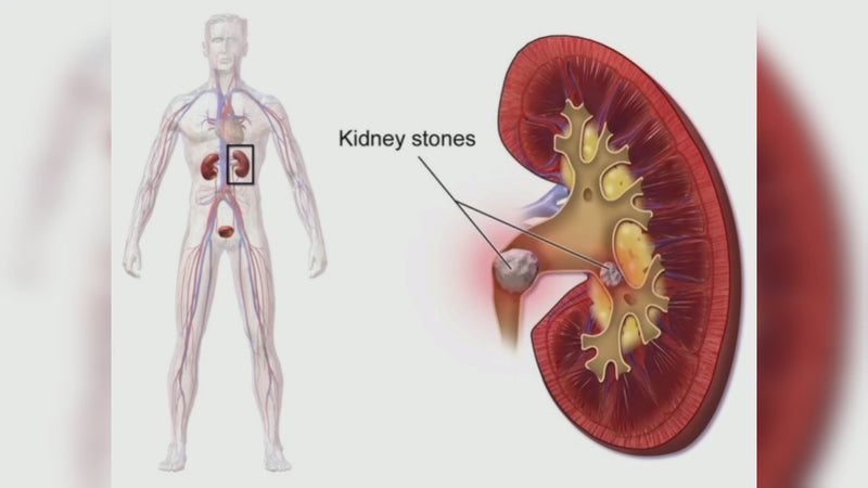 Ayurvedic UTI & Kidney Stone Support